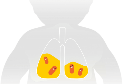 Lung